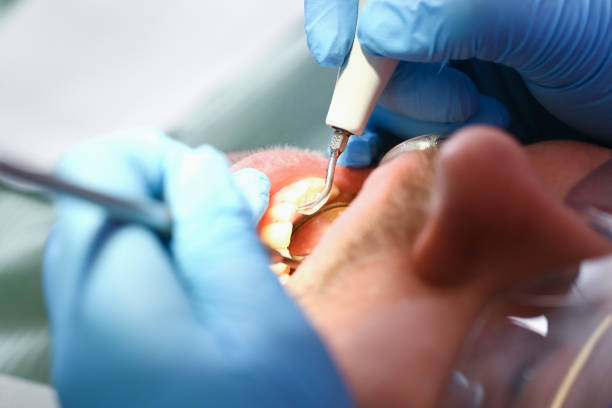 Best Lost Filling or Crown Replacement in Iona, FL