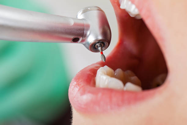Best Emergency Wisdom Tooth Extraction in Iona, FL